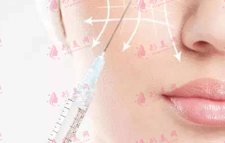 玻尿酸注射