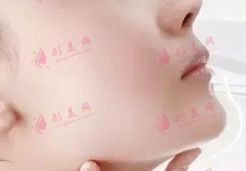 豐下巴