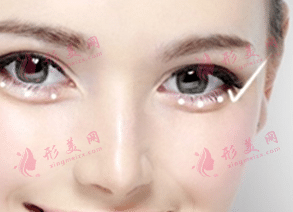 填充臥蠶