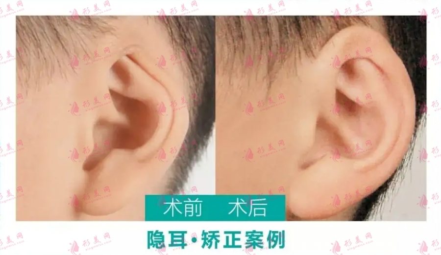小耳畸形矯正方法