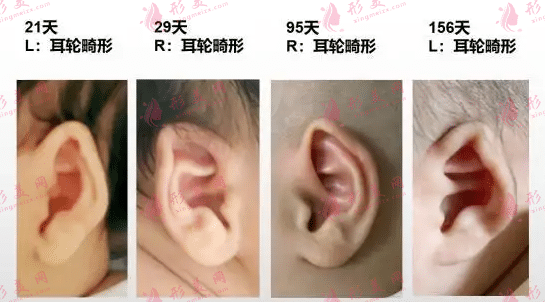 小耳畸形矯正適應(yīng)年齡
