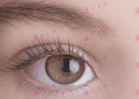 雙眼皮 雙眼皮