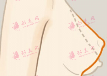 乳房下垂矯正