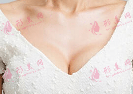 自體脂肪填充胸部