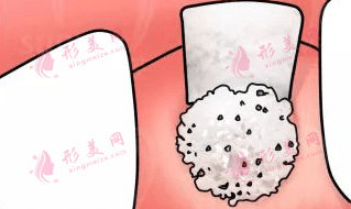 種植牙骨粉 種植牙骨粉