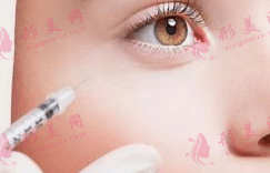 自體脂肪填充臥蠶