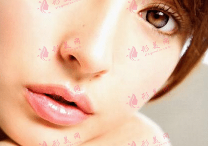 鼻翼縮小 鼻翼縮小