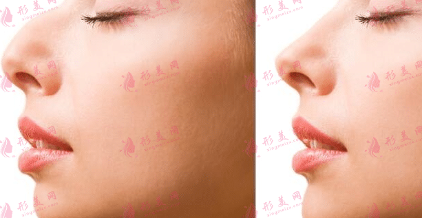 駝峰鼻矯正前后對比