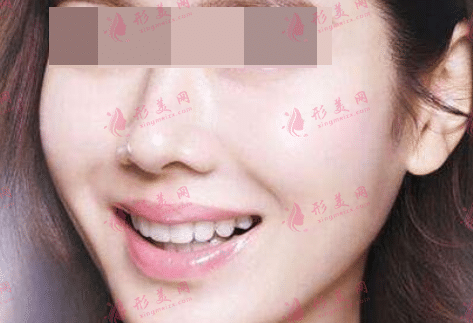 自體面部填充