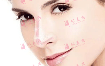 肋軟骨隆鼻