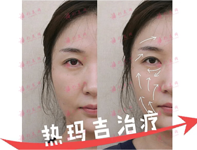 上海九院熱瑪吉案例