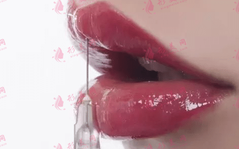 玻尿酸豐唇