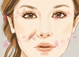 激光祛疤的優(yōu)勢(shì)|激光祛疤能維持多長時(shí)間？