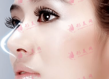 鼻翼縮小