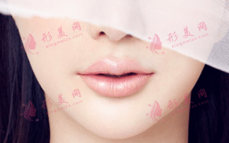 玻尿酸填充法令紋