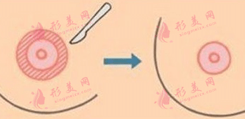 乳暈縮小