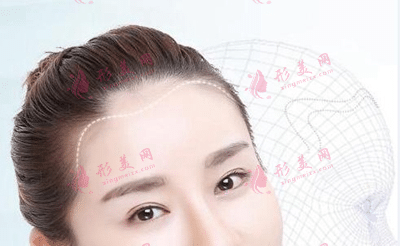 深圳科發(fā)源發(fā)際線種植好不好
