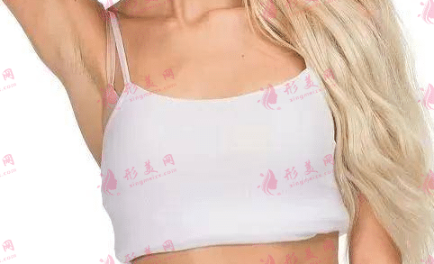 胸部奧美定取出