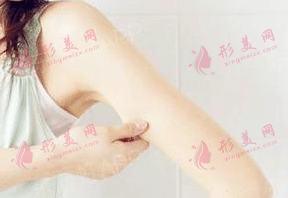 手臂吸脂 手臂吸脂