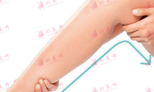 哪些情況適合做小腿吸脂？