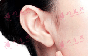 自體脂肪豐耳垂