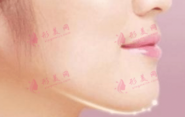 假體墊下巴