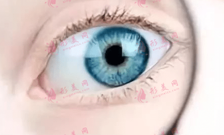 正常雙眼皮