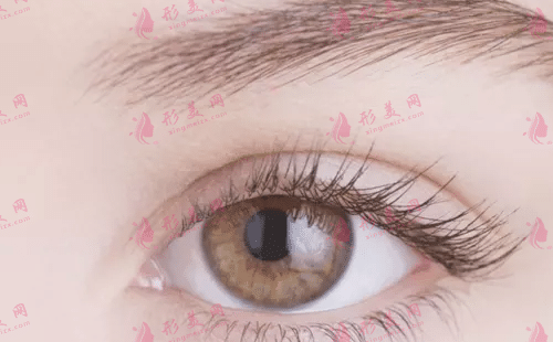 雙眼皮