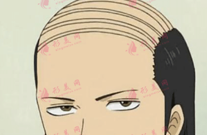 脫發(fā)