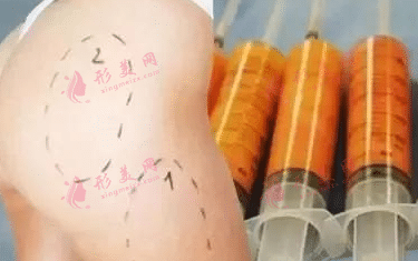 自體脂肪移植