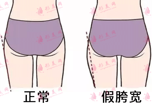 假胯寬