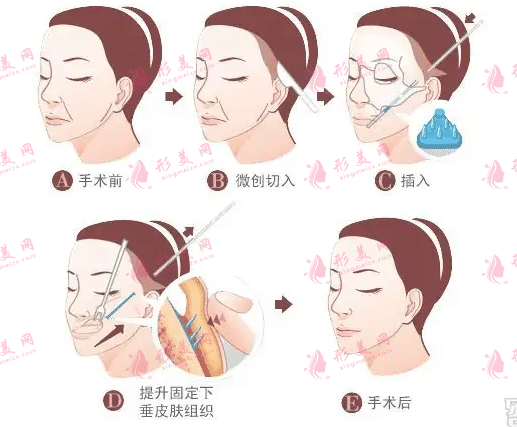 　　上海九院拉皮價格表
