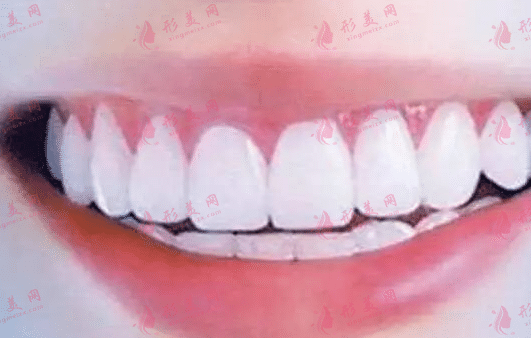 冷光牙齒美白