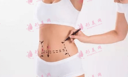 吸脂手術(shù) 吸脂手術(shù)