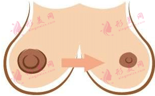乳頭縮小手術(shù)