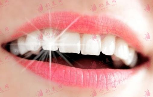 牙齒美白
