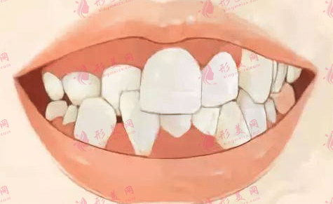 牙齒矯正
