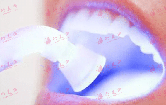 冷光美白牙齒