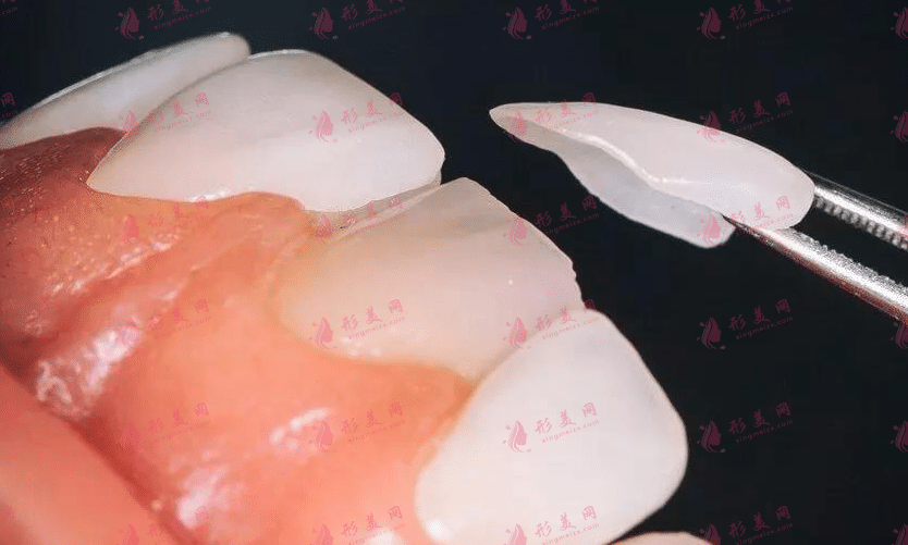 牙貼面