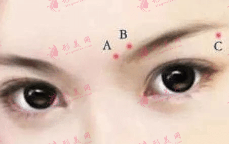 提眉術(shù)