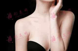 自體脂肪隆胸