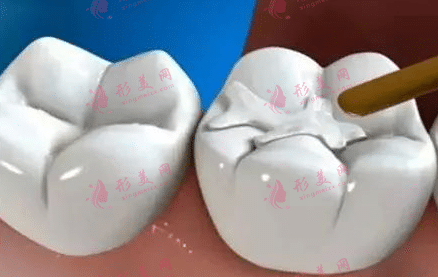  補(bǔ)牙洞