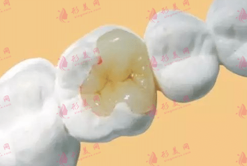 補(bǔ)牙