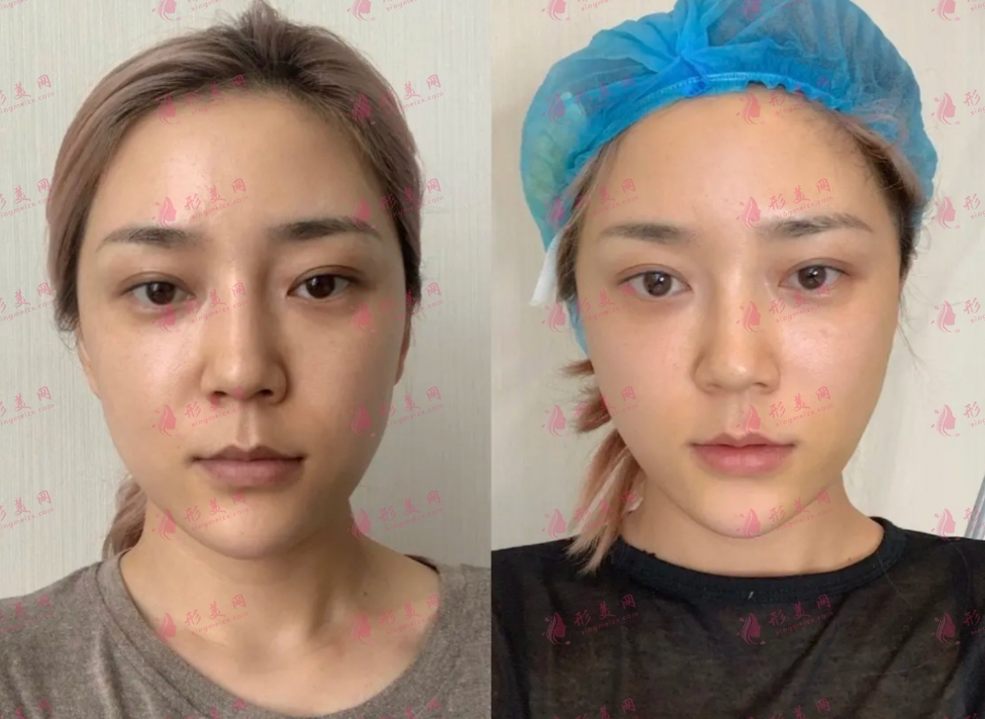 埋線提升和線雕有區(qū)別嗎？附上原理+副作用介紹！