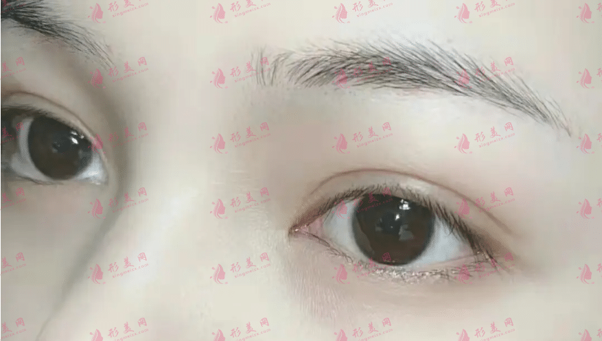 雙眼皮手術(shù)后恢復自然需要多長時間?