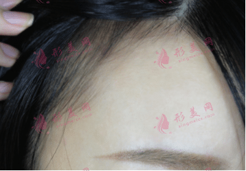 發(fā)際線種植后長(zhǎng)出來的頭發(fā)還會(huì)再掉嗎?