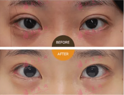 雙眼皮失敗修復(fù)方法有哪些?