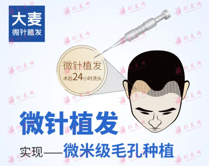大麥微針植發(fā)是正規(guī)醫(yī)院?jiǎn)?？植發(fā)費(fèi)用貴嗎？附收費(fèi)價(jià)格表