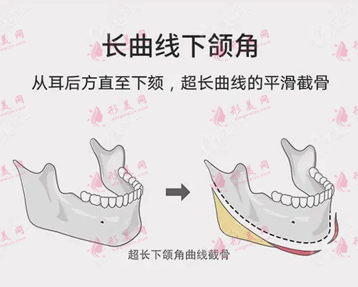 下頜角整形是怎樣操作?