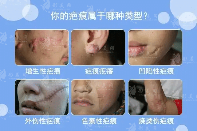 上海皮膚病醫(yī)院，虹橋醫(yī)院疤痕修復(fù)怎么樣？含傷疤修復(fù)價格
